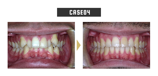 case04